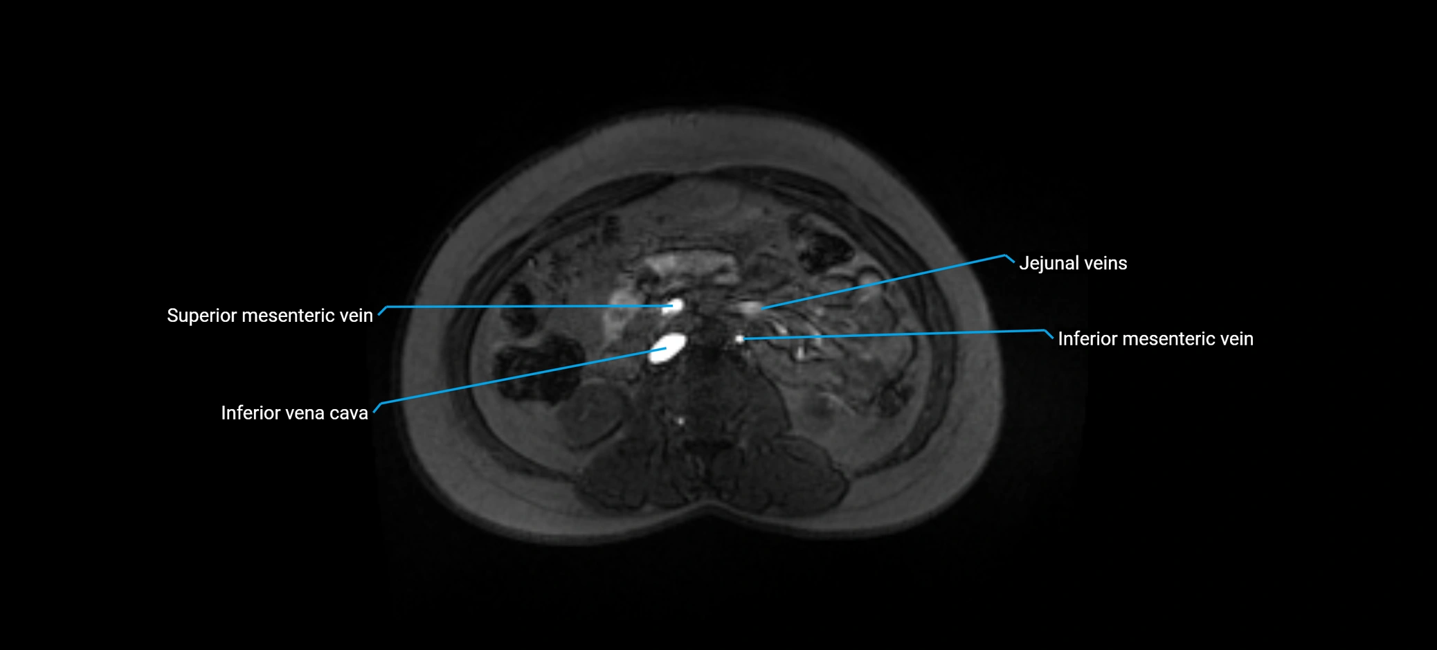 MRV abdomen pelvis & lower limb axial cross sectional anatomy labelled MRI image 82 (1).webp